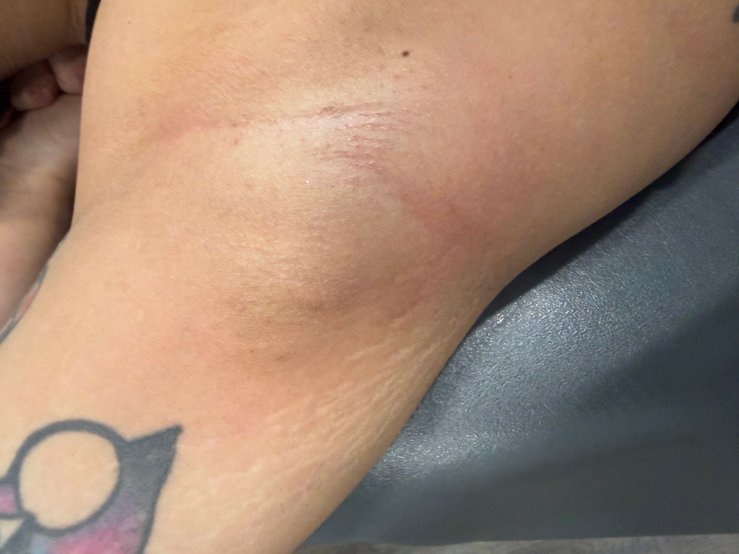 Close-up of a person's upper arm with a tattoo and a scar, resting on a dark surface.