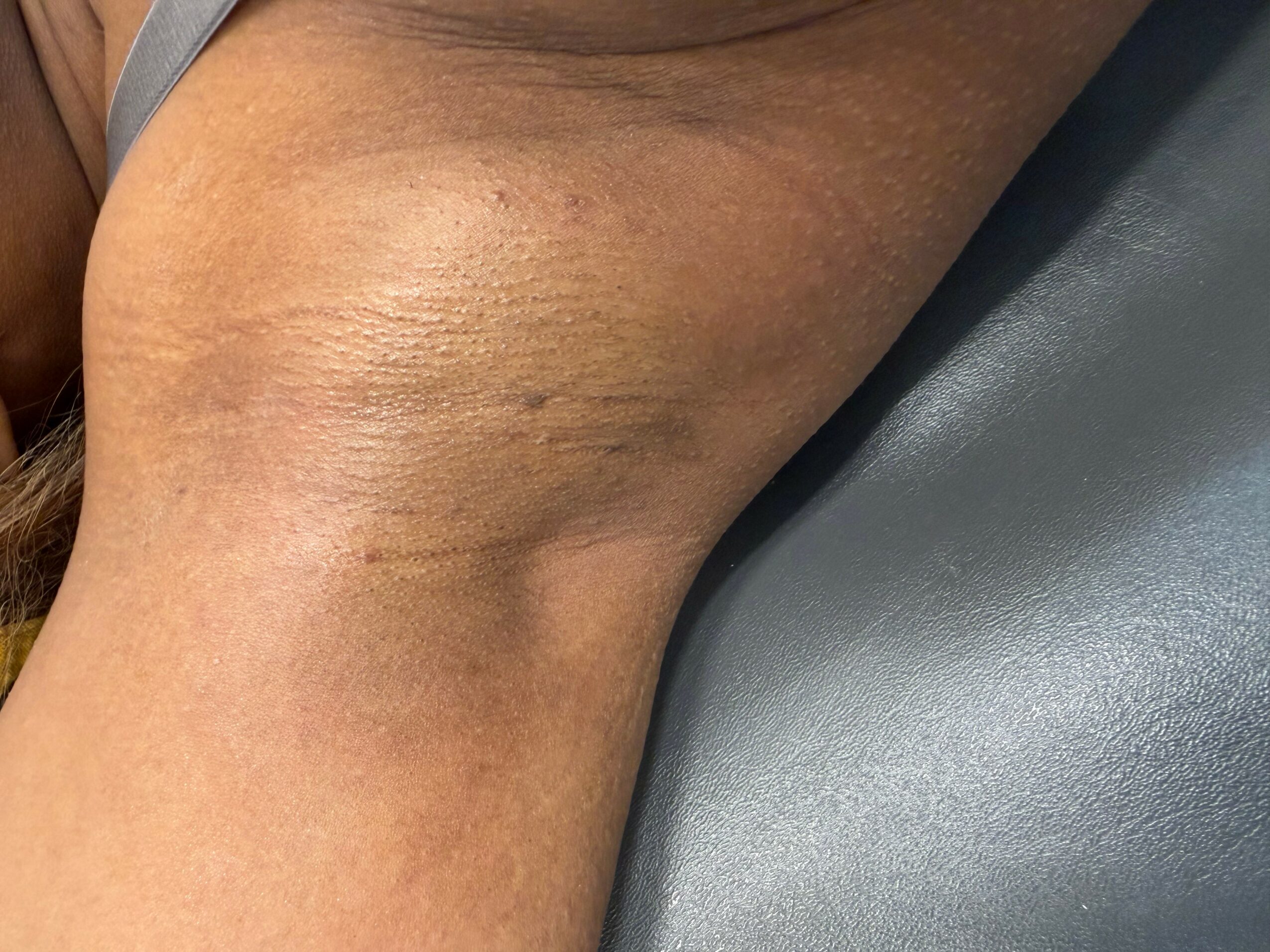 Close-up of a person's armpit with skin folds and some discoloration.