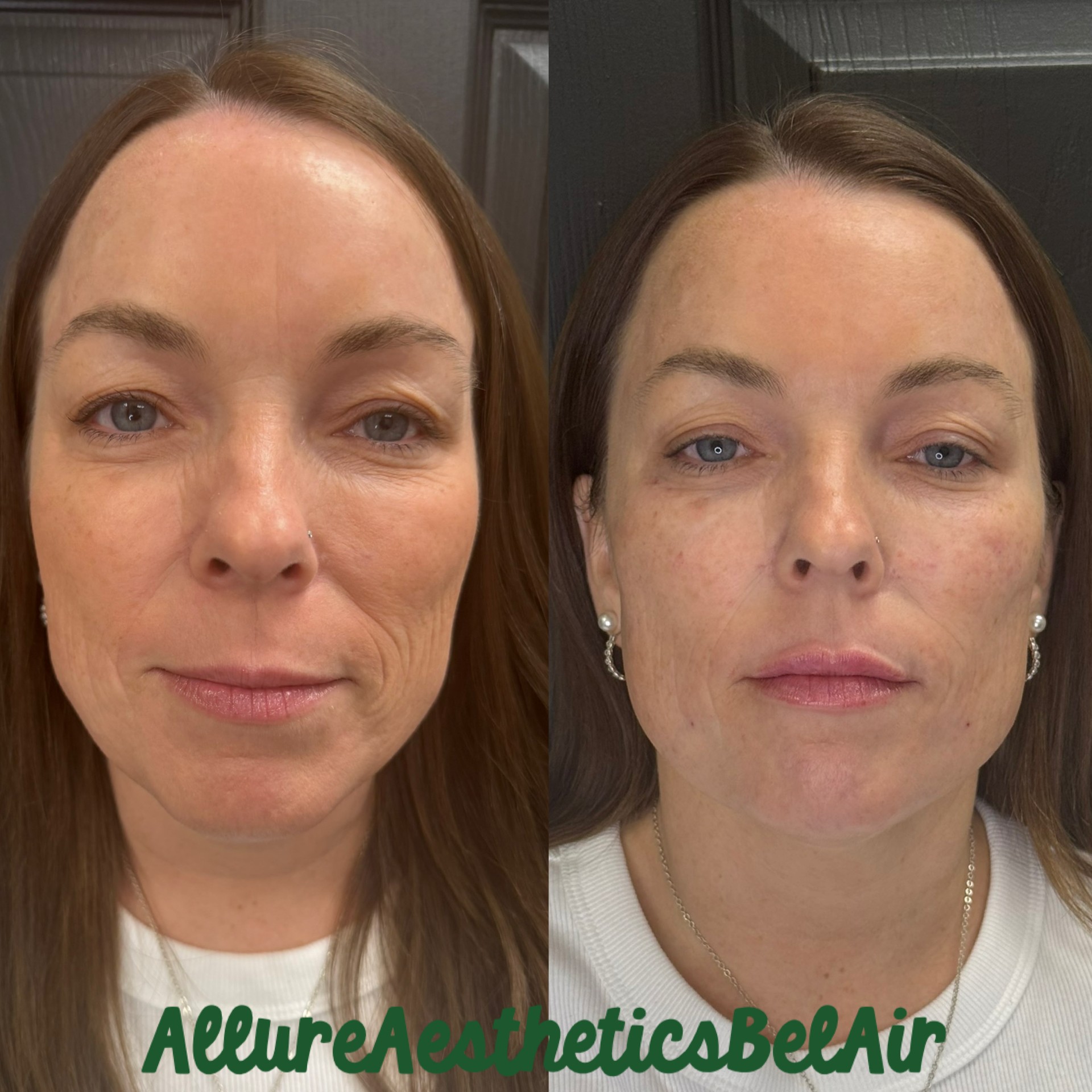 Side-by-side images of a woman before and after skincare, showing improved skin clarity and texture.