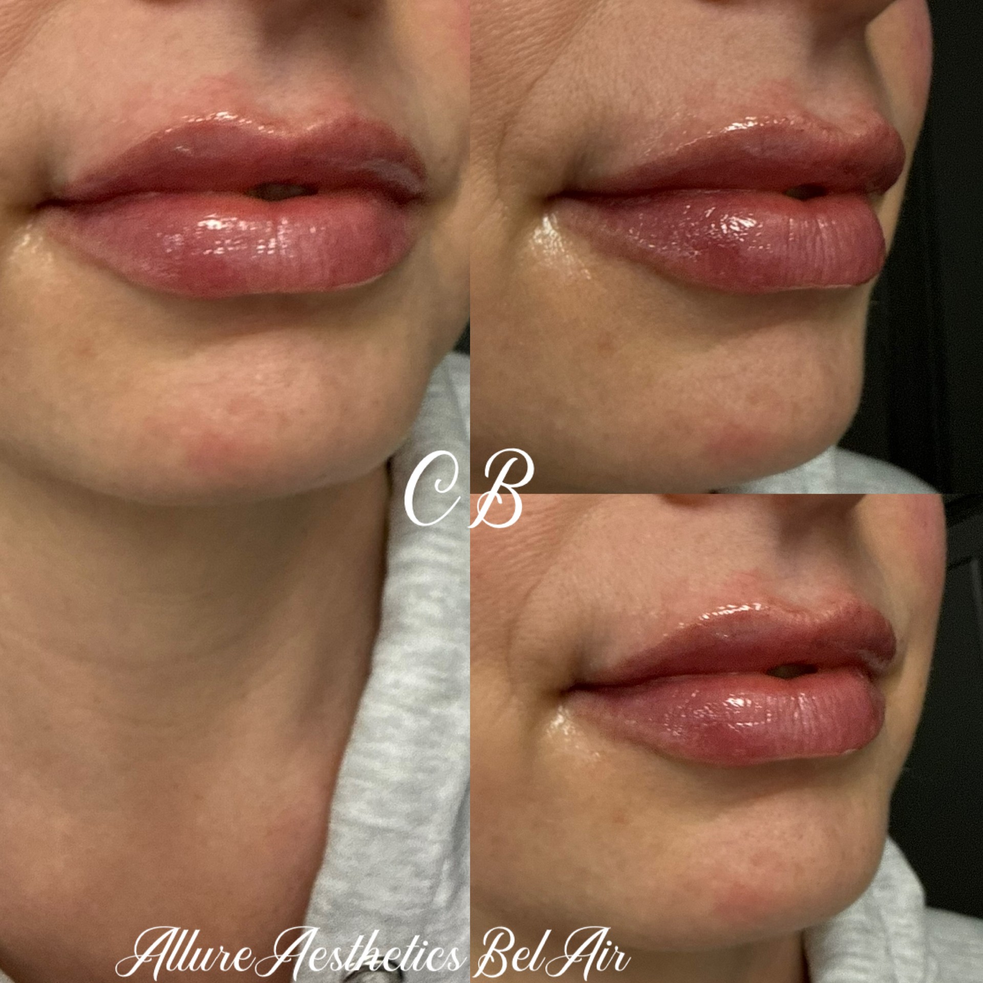 Close-up of lips before and after cosmetic enhancement, showing fuller, plumper lips with a glossy finish.