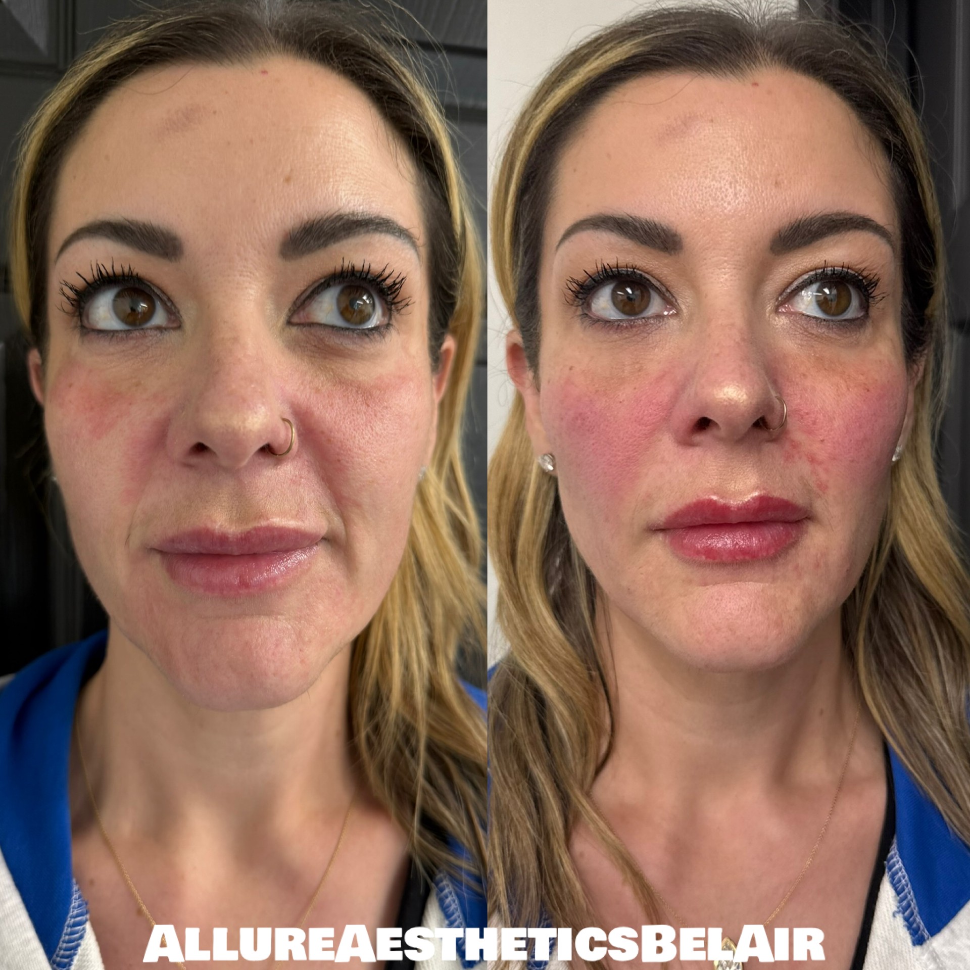 Side-by-side images of a woman before and after cosmetic treatment, showing improved skin and fuller lips, with visible redness and makeup.